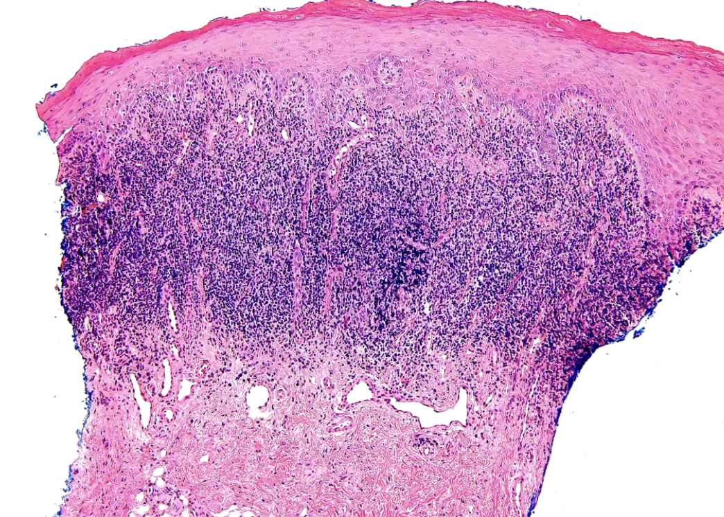 <p>what are some histopathologic features of lichen planus?</p>