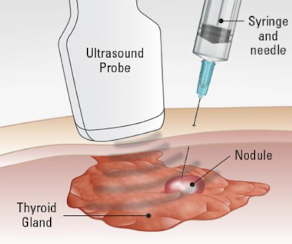 <ul><li><p>uses a <span style="color: yellow;">20-25G needle</span> with cutting tip, such as Fransen, Chiba, or spinal needle</p></li><li><p>uses a thin needle to collect cells from a mass for cytology evaluation</p></li><li><p><span style="color: yellow;">if sample is too small</span>, <span style="color: yellow;">suction technique</span> may be used:</p><ul><li><p>a syringe and tubing are attached to the needle</p></li><li><p>this suction helps draw cells into the needle during sampling</p></li></ul></li><li><p>reduces potential trauma to cells and decrease the amount of blood retrieves as well</p></li><li><p>FNA helps:</p><ul><li><p><span style="color: yellow;">reduce trauma to cells</span></p></li><li><p><span style="color: yellow;">decrease the amount of blood retrieved</span></p></li><li><p>decrease background blood contamination</p></li><li><p>improve specimen quality for cytology</p></li></ul></li></ul><p></p>