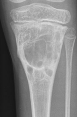 <p>What is this?</p><p>- 5-20 yo, Female</p><p>- Pain</p><p>- Metaphyseal - Femur/ TIbia, Neural arch, SP/ T, lamina, T/S, L/S, Clavicle</p>