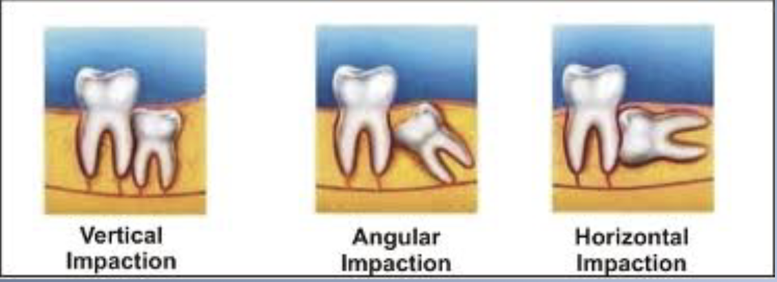 <p><span>1. Late crowding develops at about the time the 3M should erupt.</span><br><span>2. Most individuals show hopeless impaction of 3M.</span><br><span>3. Difficult to detect such a force</span></p><p><span>1. Late crowding of lower incisors can, and often does, develop in individuals with congenitally missing 3M.</span><br><span>2. Evidence that incisor crowding may be lessened by early removal of 2M.</span><br><span>3. Pressure of the 3M clearly is not the total explanation either.</span></p>