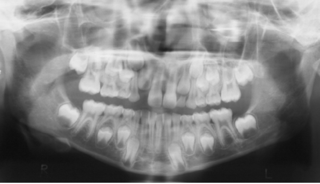 <p><span>This patient is 7 years old.&nbsp; Mandibular centrals and laterals have erupted as well as maxillary centrals.&nbsp; Are you concerned that maxillary laterals have not yet erupted. Please see panoramic radiograph below. Which of the sentences is correct?</span></p><p></p><p>A) Maxillary lateral eruption is delayed given this patient's age.&nbsp;</p><p>B) Mandibular teeth usually erupt before the maxillary corresponding teeth, so it is not a concern maxillary laterals have not yet erupted.</p><p>C) Maxillary and mandibular corresponding teeth usually erupt at the same time, so maxillary permanent laterals may have to be brought into the arch surgically.</p><p>D) $Maxillary permanent laterals are ectopic.</p>