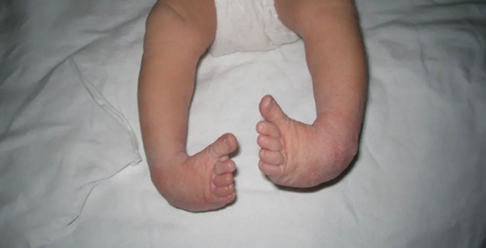 <p>Clubfoot (Deformity Components, Risk Factors, Treatment, & Nursing Tips)</p>