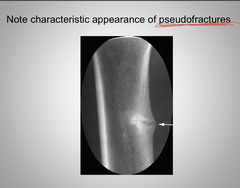 <p>Pseudofractures</p>