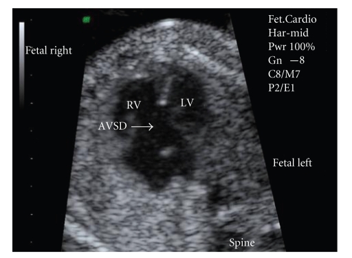 <p>4CH- absence of atrial/ ventricular septum </p><p>lack of apical offset of MV, TV</p>