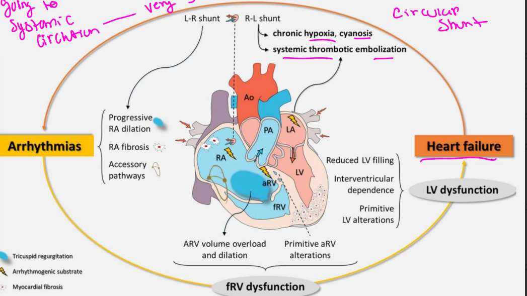 <p>This circular shunt may lead to rapid deterioration in utero or neonatally and carries a very poor outcome ( Chronic hypoxia, cyanosis, systemic thrombotic embolization, HF)</p>