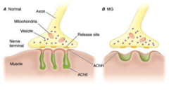 <p>Antibodies directed against acetylcholine receptors on the muscle surface --> receptor destruction --> weakness</p>