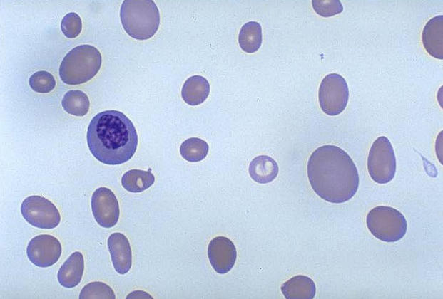 <p>what would the RBC morphology look like in those with pernicious anemia? <strong>(learning objective)</strong></p>
