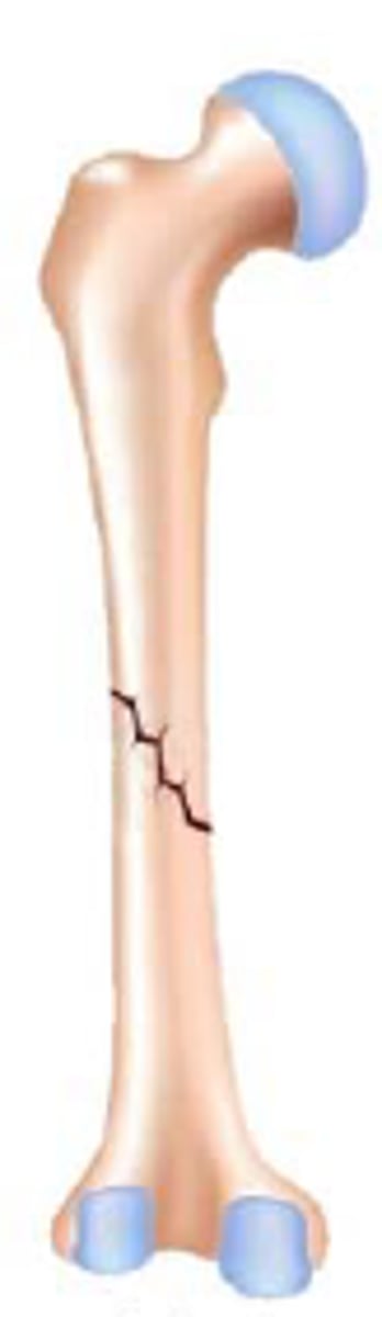 <p>a bone fracture that runs diagonally across a bone</p>