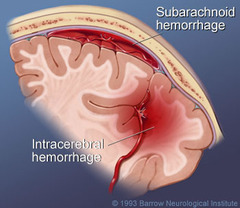 <p>Rupture of cerebral blood vessel</p><p>Blood increases outside of vascular space → compresses brain</p><p>(higher mortality rate than ischemia)</p>