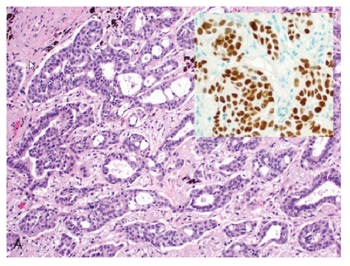 <ul><li><p>Glandular differentiation</p></li><li><p>Mucin production</p></li></ul><p></p>