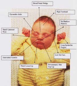 What Is Fetal Valproate Spectrum Disorder & Fetal Anti Convulsant Syndrome – INFACT