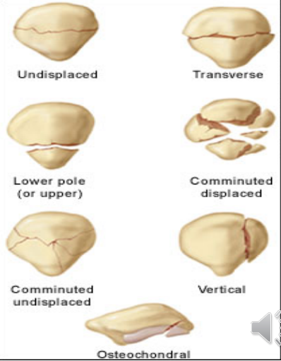 <ul><li><p>mechanism of injury </p><ul><li><p>direct violence (dashboard + knee → comminuted #) </p></li><li><p>indirect violence (strong muscle contraction pull off patella → transverse #)</p></li></ul></li></ul><p></p><p>Types of # patterns</p><ul><li><p>comminuted #<br>transverse #</p></li><li><p>undisplaced #</p></li><li><p>displaced #</p></li></ul><p></p>