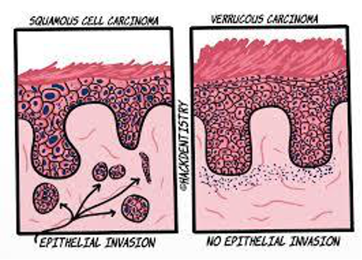 <p>CASE: A broad verruciform oral tumor has architecture consistent with verrucous carcinoma. Why is distinguishing it from conventional SCC clinically important?</p>