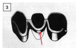 <p>lingual metal collar</p>