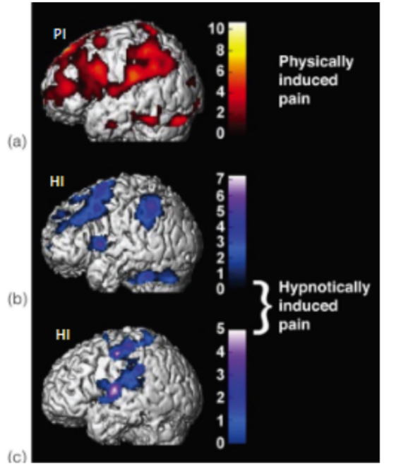 <p>true</p><ul><li><p>painful stimulus projects up through <u>spinothalamic tract</u> &amp; <u>rubbing skin will activate touch mechanoreceptor</u>s, which <strong><u>release signals into SC</u></strong> → activate <strong><u>SG- cells in dorsal horn of SC</u></strong> (which suppresses transmission of pain signals)</p></li></ul><p>__</p><p>to study hypnotically induced pain (aka only told that they feel pain when hypnotized)</p><ul><li><p>participants had thermal stimulator attached to palm of hand</p></li><li><p>3 conditions:</p><ul><li><p><u>p</u>hysically <u>i</u>nduced pain (PI)</p></li><li><p><u>h</u>ypnotically <u>i</u>nduced pain (HI)</p></li><li><p>control group that <u>im</u>agined the painful stimulation (IM)</p></li></ul></li></ul><p>results: <strong><u>hypnosis can produce pain perception without painful stimulus</u></strong></p><p>__</p><p>another experiment where participants could keep their hands in cold water longer when shown positive pictures</p><ul><li><p>due to <u>emotional distraction</u> (shows how cognitive system/state can affect pain perception)</p></li></ul><div data-type="horizontalRule"><hr></div><p>(picture)</p><p>despite regions in PI, HI, and IM conditions having some overlap in their activated regions, <u>whether they </u><strong><u>feel pain or not</u></strong><u> is deter. by their </u><strong><u>cognitive state</u></strong></p>