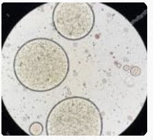 <p>seen in stool microscopic stool exam if patient has malabsorption, pancreatic enzyme deficiency, bile deficiency</p>