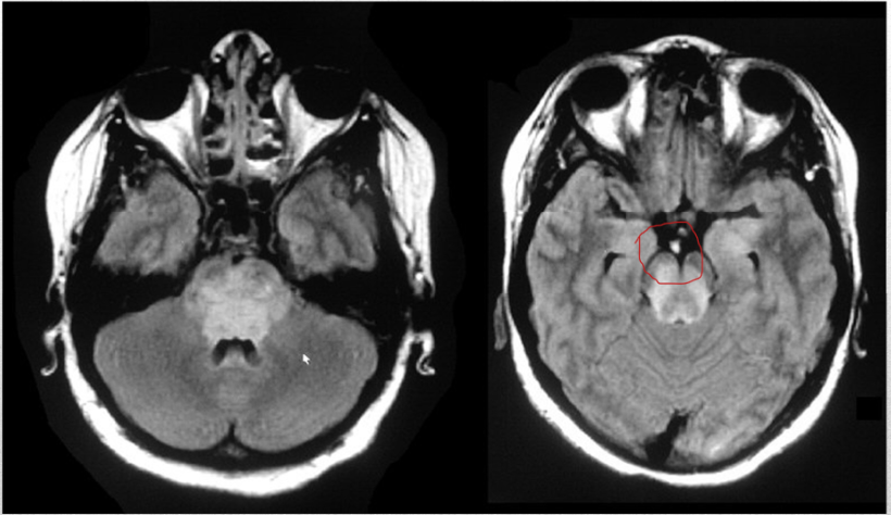 <p>occlusion of this artery leads to coma with pinpoint pupils, flaccid quadriplegia, and sensory loss, and variable CN abnormalities</p>