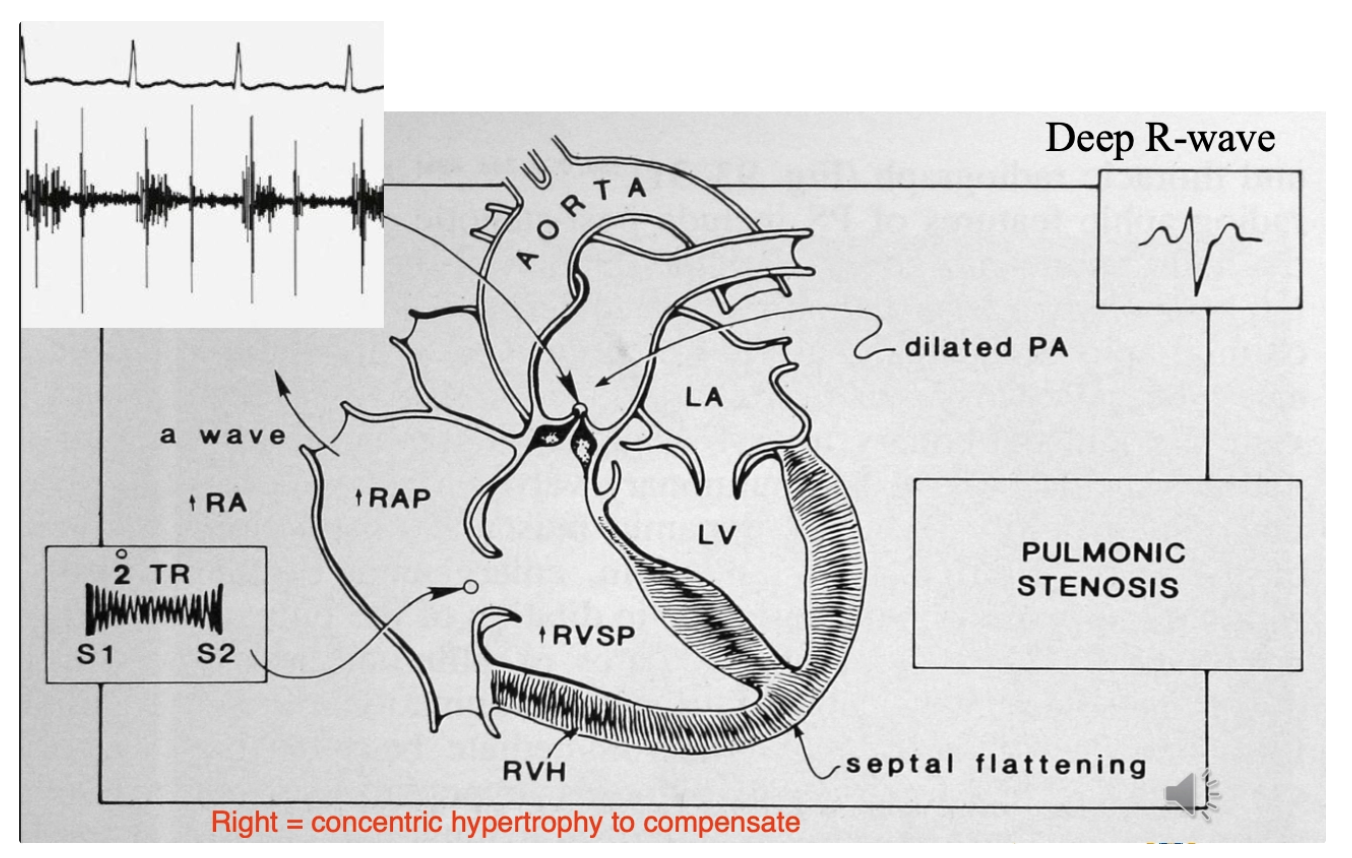 <p><u>Prevalence:</u> Common congenital valvular defect in dogs</p><p><u>Sites:</u> Valvular #1 (> subvalvular > supravalvular)</p><p><u>Signalment:</u> Small breed dogs (beagle, Newfoundland, samoyed, Chihuahua, English bulldog, GR, Chow Chow, mini schnauzer)</p><ul><li><p>Normally >1yr</p></li></ul><p><u>Pathogenesis:</u></p><ol><li><p>Congenital narrowing of pulmonic valve → Obstruction to RV outflow</p></li><li><p>Concentric hypertrophy of RV</p></li><li><p>± RCHF</p></li></ol><p></p>