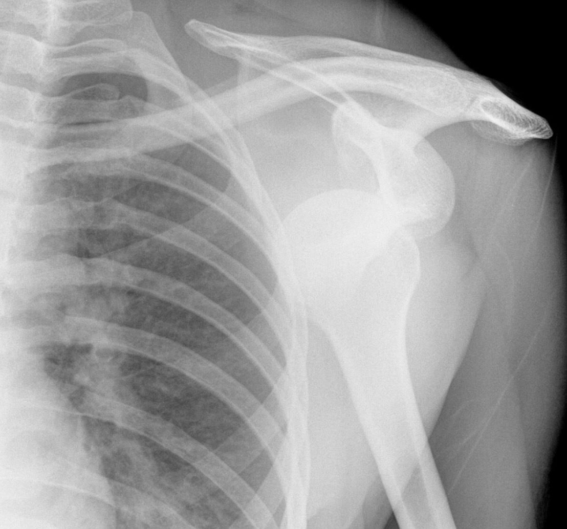 <p>Shoulder dislocation (Anterior) <span data-name="star" data-type="emoji">⭐</span></p>