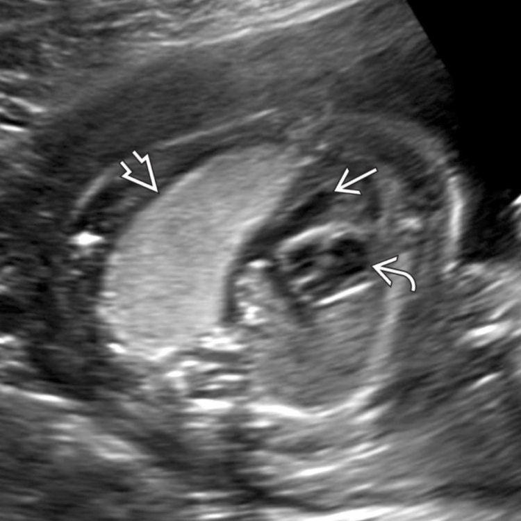 <p>Microcystic, cysts are too small to be seen </p><p>entire mass is echogenic </p>
