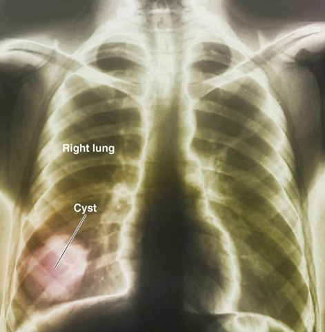 <p>Pathogen → Echinococcus granulosus</p><p>Symptoms → Larvae form in body; may be very large and cause damage</p><p>Reservoir → Intermediate host: sheep, humans</p><ul><li><p>Definitive host: dogs</p></li></ul><p>Diagnostic test → Serology; X-ray exam</p><p>Treatment → Surgical removal; albendazole</p><p>*Develops a hydatid cyst that can grow and hold up to 15 liters of fluid; May rupture, causing anaphylactic shock</p>