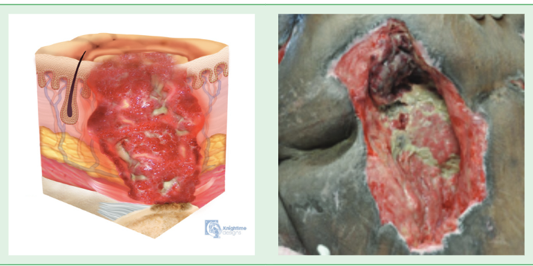 <p>Full-thickness loss of skin and tissue </p><ul><li><p>Fascia, muscle, tendon ligament, cartilage, and/or bone exposed</p></li></ul><p></p>