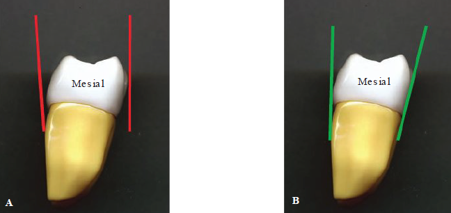<p><span style="color: rgb(255, 0, 0);"><strong>A: Incorrect </strong></span></p><ul><li><p>Red lines — incorrect alignment to lingual and facial surfaces of mandibular molar</p></li></ul><p></p><p><span style="color: green;"><strong>B: Correct</strong></span></p><ul><li><p>Green lines — Correct alignment to lingual and facial surfaces of mandibular molar</p></li></ul><p></p>