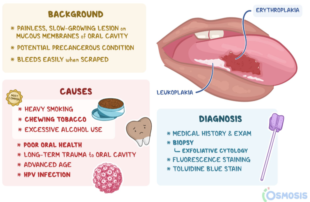 <p>Usually affects the tongue, and presents as a <strong><u>nonhealing ulcer with irregular margins and raised borders</u></strong></p><p><strong><u>Leukoplakia</u></strong> may also be noted and <br><strong><u>Erythroplakia</u></strong> are precursor lesions</p>