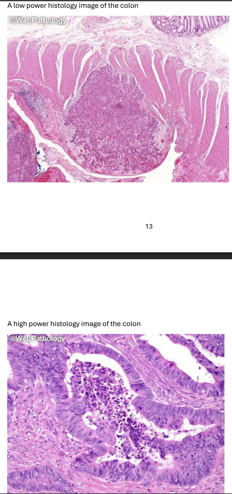 <p>Describe the architecture of the histological section, comment on the cytology, identify the pathological process and give a diagnosis.</p>