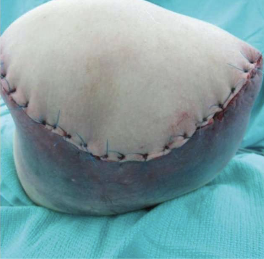 <p>Things to observe on new RL<br>Dog Ears<br>Sutures<br>Tissue density/ skin condition<br>Color<br>Drainage/ Discharge<br>Odor</p>