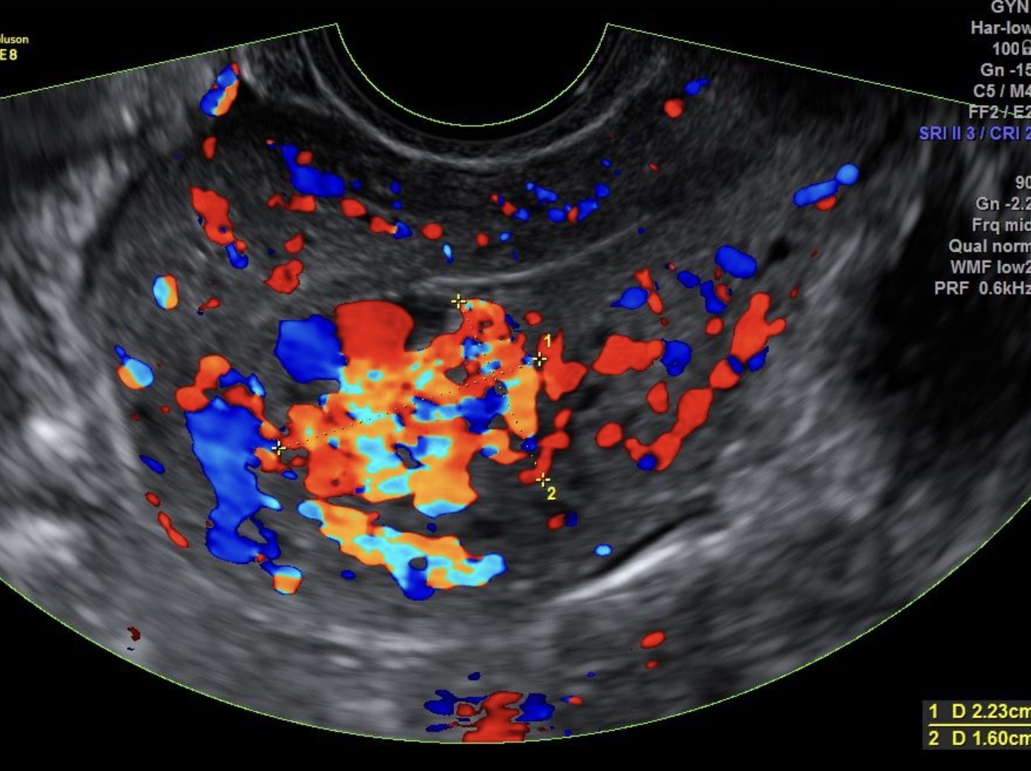 <p>What pathology is seen in this image?</p>