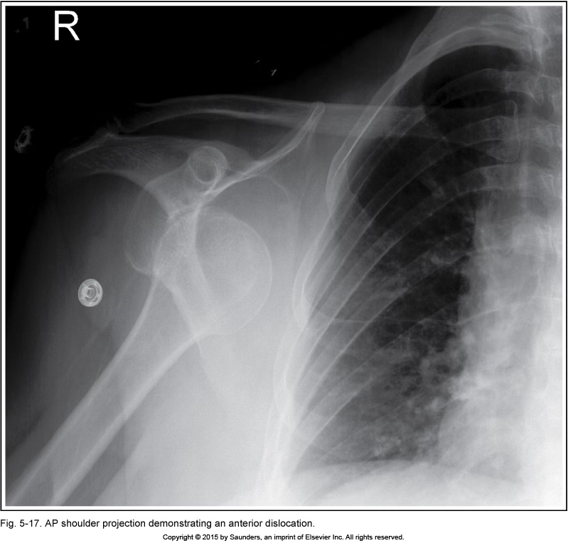 <p>AP shoulder (dislocation)</p>