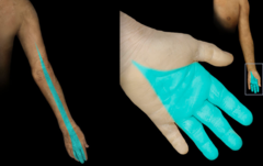 <p>D: Lateral arm and forearm to index, long, and ring fingers</p><p>M:</p>