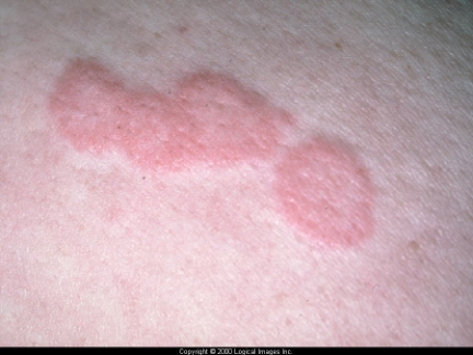 <p><span>•Weal, wheal or Hive:</span></p><p><span>–Central swelling of variable size, surrounded by erythema. Dermal oedema</span></p><p><span>–itching, sometimes burning</span></p><p><span>•Histamine release into dermis</span></p><p><span>–fleeting nature, duration: 1- 24 hours</span></p><p><span>•Angioedema</span></p><p><span>–Deeper swelling of the skin or mucous membranes </span></p>