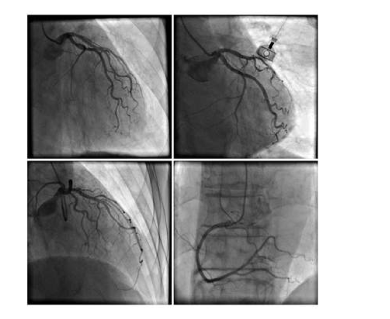 <p><span style="line-height: normal;">• </span>Helps in the detailed viewing of vertebral and carotid arteries, cerebral arterial circulation</p><p class="p1"><span style="line-height: normal;">• </span>Highlights presence of leaking vessels, aneurysms, and occluded blood vessels</p><p class="p1"><span style="line-height: normal;">• </span>Performed through injection of a contrast medium into the artery through a catheter</p>