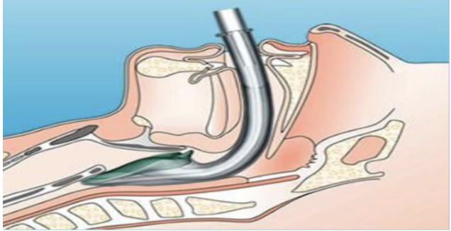 <ul><li><p>Is inserted through the mouth to above the larynx</p></li><li><p>Used on patients who are unconscious (no active gag reflex)  </p></li><li><p>Forms a seal around the laryngeal inlet</p></li><li><p>Allows ventilation without intubation</p></li><li><p>However Does NOT fully protect against aspiration</p></li></ul><p></p>