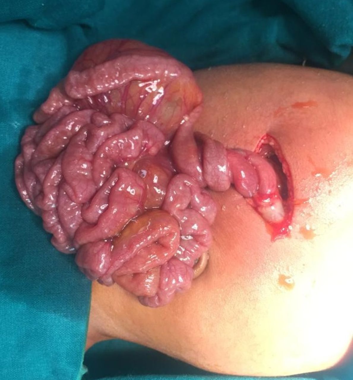 <p><span>volvulus</span></p>
