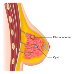 <p>CM: smooth, non-tender, mobile lump in breast</p><p>Can grow over time</p><p>Doesn't get bigger nor smaller with menstruation</p>