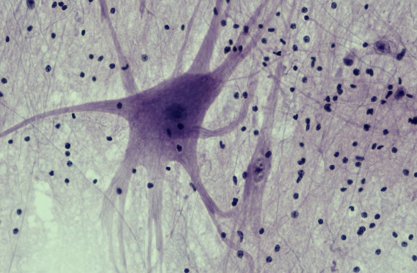 <ol><li><p>Sickle Cell Anemia</p></li><li><p>Atherosclerosis</p></li><li><p>Adenocarcinoma of Kidney</p></li><li><p>Osteogenic Sarcoma of Bone</p></li><li><p>Tattoo in Human Skin</p></li><li><p>Neurilemmoma</p></li><li><p>Anthracosis of the Lung</p></li><li><p>Basal Cell Carcinoma</p></li><li><p>Lung</p></li><li><p>Skeletal</p></li><li><p>Kidney</p></li><li><p>Neuron</p></li><li><p>Skin</p></li><li><p>Blood</p></li><li><p>Bone</p></li><li><p>Aorta</p></li></ol><p></p>