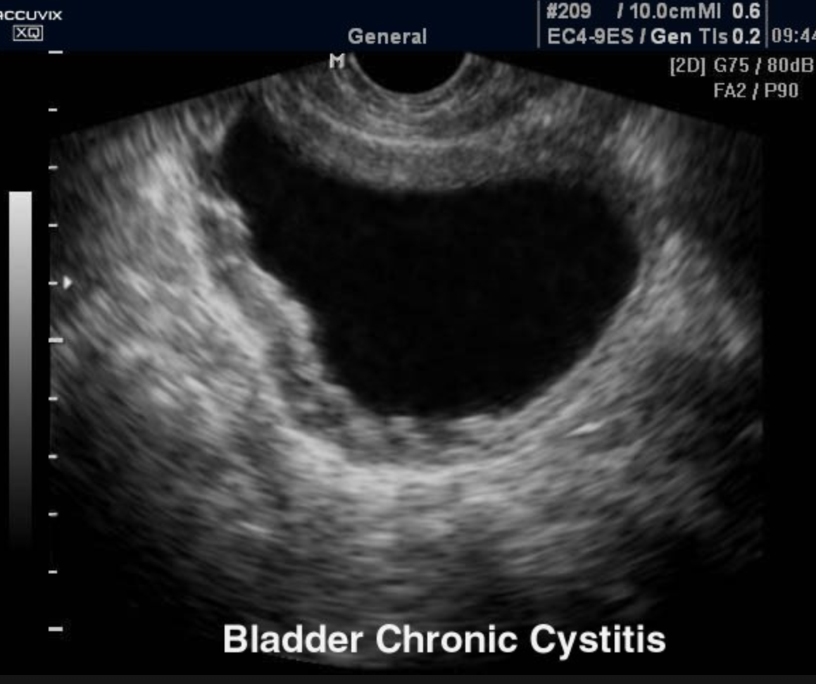 <p>scarring and trabeculation of bladder wall</p>