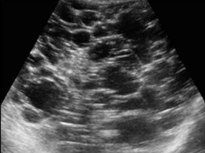 <p>what dx is this and describe the sonography</p>