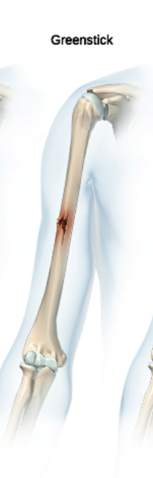 <p>partial breaks in a bone that occur as a result of bending</p>