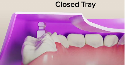 <p>Closed-tray technique </p>