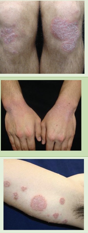 <p>Plaque: raised area of skin with large, flat elevation >1cm</p><p>EX:</p><ul><li><p>plaque psoriasis: scattered, erythematous or bright pink, flat-tooped plaques w/ overlying silvery scale MC on <em>extensor</em> surfaces in childhood (eg. elbow crease)</p></li><li><p>atopic dermatitis: bilateral eczamatous plaques, poorly circumscribed and often lichenified (thickened skin from rubbing/scratching) MC of <em>flexor</em> surfaces (eg. knees/elbows)</p></li><li><p>nummular dermatitis: mult, round coin-like exzematous plaques w/ overlying transudative crust</p></li><li><p>pityriasis rosea rash: mult, round, violaceous plaques</p></li><li><p>herald patch <em>of pityriasis rosea</em>: single oval, raised but flat-topped plaque</p><ul><li><p>initial sign of pityriasis rosea</p></li></ul></li></ul><p></p>