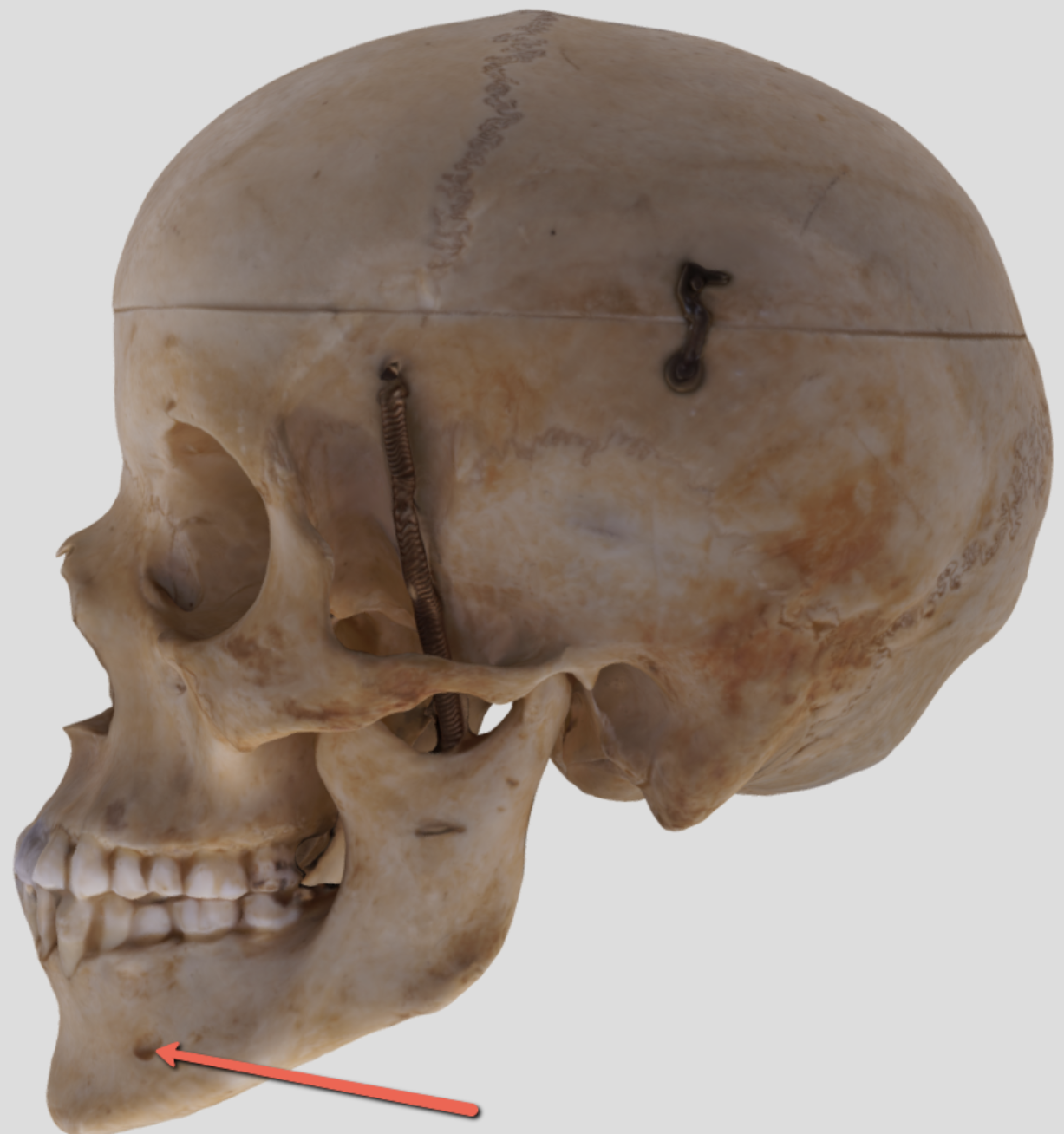 <p><span><strong>Identify the bone marking indicated by the pointer.</strong></span></p>