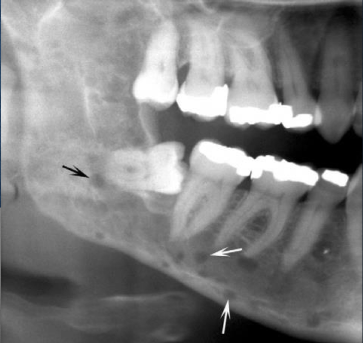 <p>sharp boundary but no radiopaque line</p><p>surrounding bone appears normal</p>
