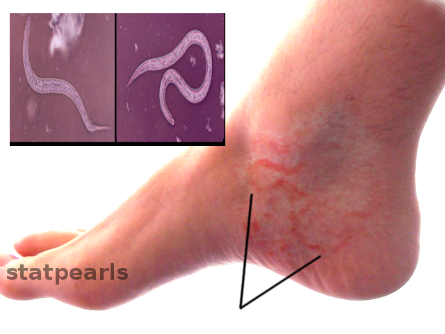 <ul><li><p>parasitic </p></li><li><p>round worm that feeds on human blood</p></li><li><p>pinworms are similar… just smaller</p></li></ul><p></p>