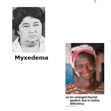 <ul><li><p>If due to lack of iodine, a <strong>goiter </strong>may develop</p><ul><li><p>not enough thyroid hormone so thyroid glands ramps up amount of thyroglobulin but there is not iodine to collect precursor, thus enlargement of thyroid gland</p></li></ul></li><li><p>↑ synthesize of unusable thyroglobulin causes thyroid to enlarge</p></li></ul><p></p>
