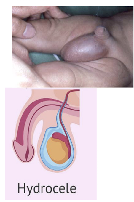 <p>collection of serous fluid within the processus vaginalis surrounding the testicle.</p><ul><li><p>very common </p></li><li><p>usually unilateral, sometimes bilateral </p></li></ul><p></p>