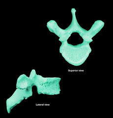 <p>disarticulated</p>